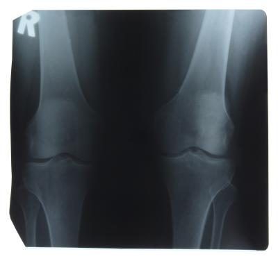 L'articulation du genou est particulièrement vulnérable aux blessures et l'arthrite.