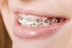 Tu'll find many options for financial help to afford kid's braces.