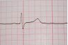 Un ECG normal démontrant la pointe de QRS de hauteur et une onde T.