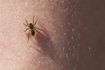 Une araignée rampe sur une peau de personnes.
